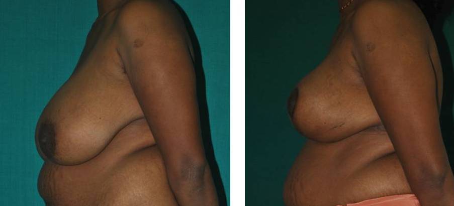Breast reduction and lift in Kerala